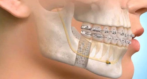 Fasciomaxillary Surgery